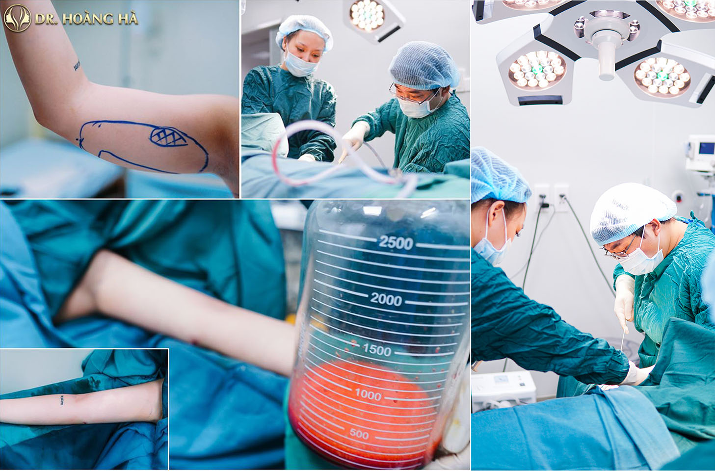 Quy trình hút mỡ bắp tay tại Dr Hoàng Hà