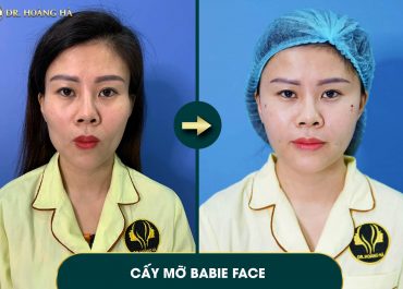 Cấy mỡ có cần làm nhiều lần không? Giải đáp từ chuyên gia thẩm mỹ