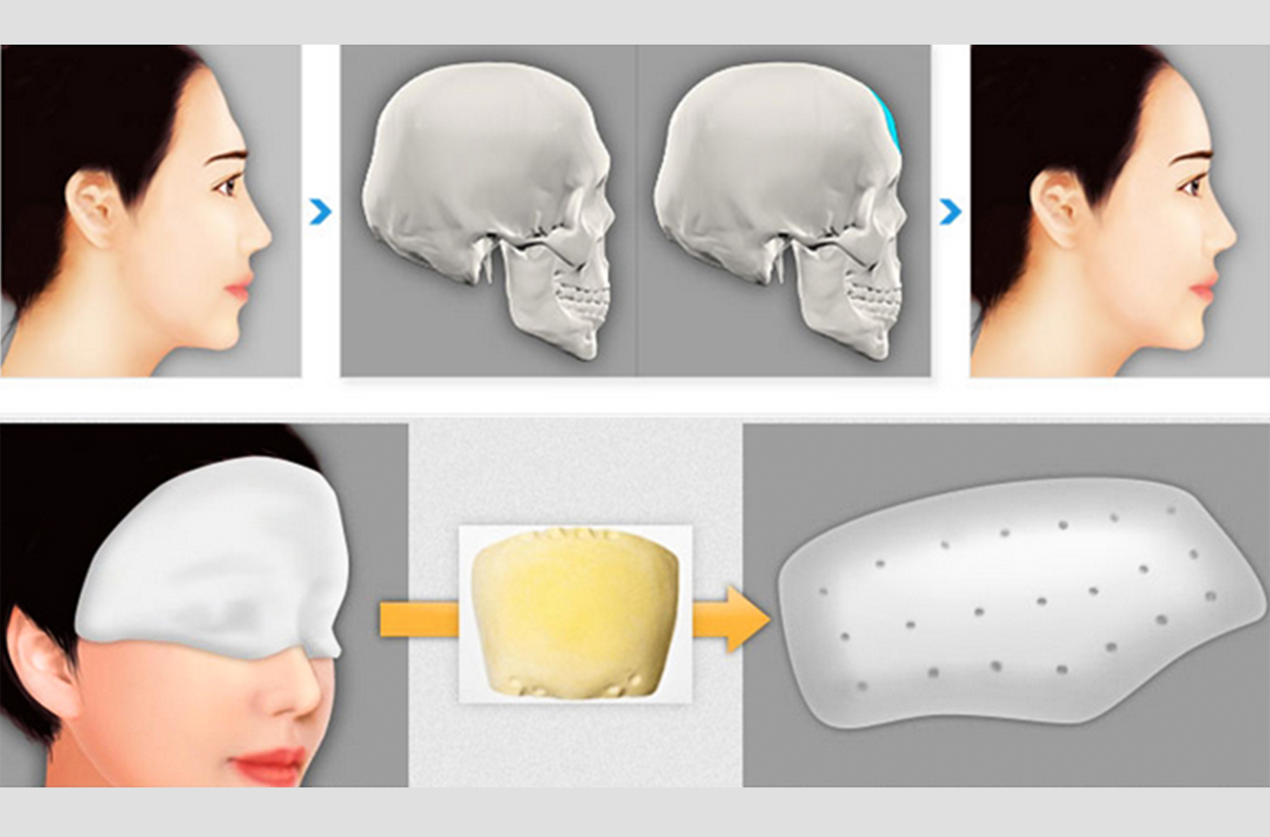 Mô phỏng quy trình độn trán