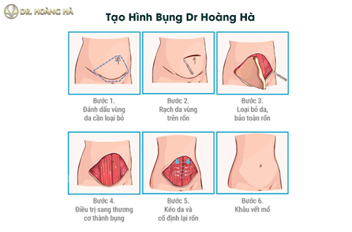 Quy trình phẫu thuật Tạo hình thành bụng