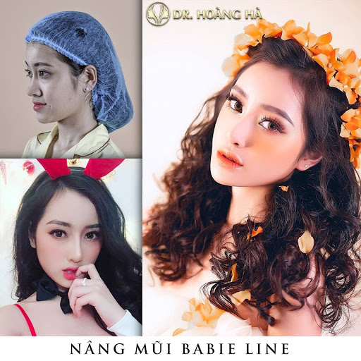 Khách hàng sau khi nâng mũi Babie line