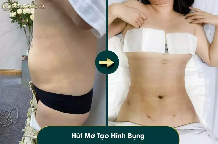 Bụng gọn, eo thon sau phẫu thuật hút mỡ Body-Fit tại Dr Hoàng Hà