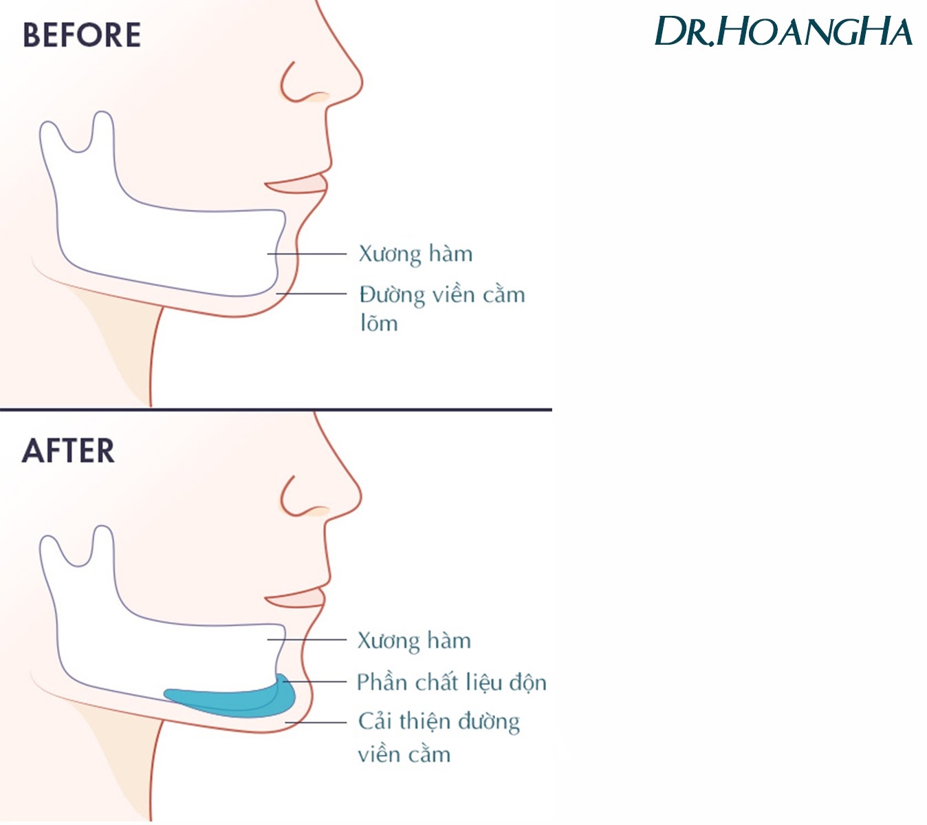 Độn cằm bao lâu thì đẹp tại Dr Hoàng Hà