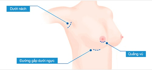 Vị trí các vết mổ để nâng ngực