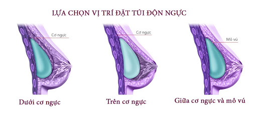 3 vị trí đặt túi độn nâng ngực an toàn thường gặp