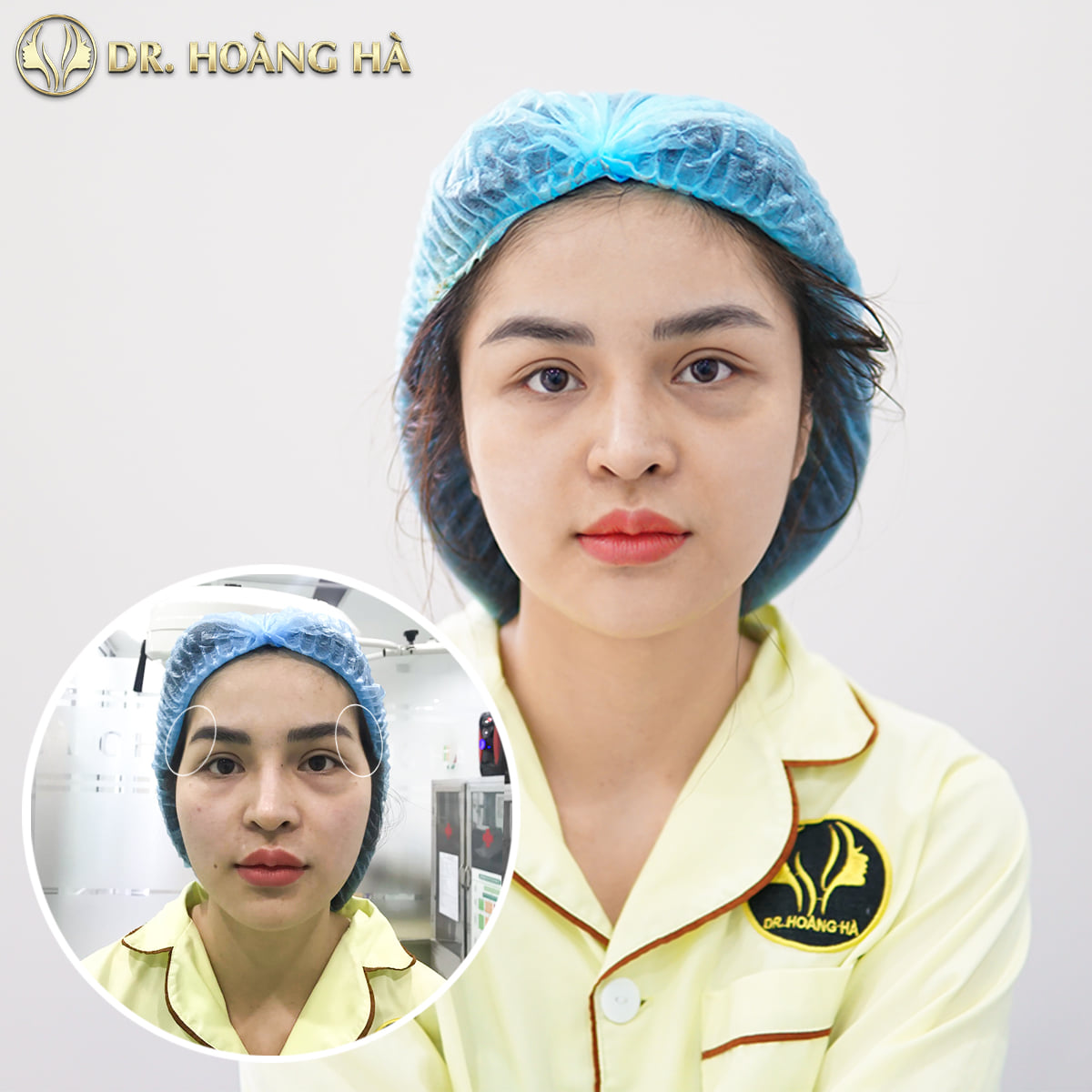 Khách hàng sau khi cấy mỡ tại Dr Hoàng Hà