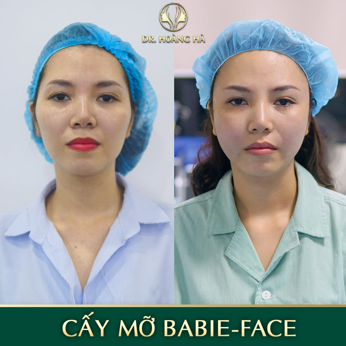Khách hàng sau khi cấy mỡ tại Dr Hoàng Hà