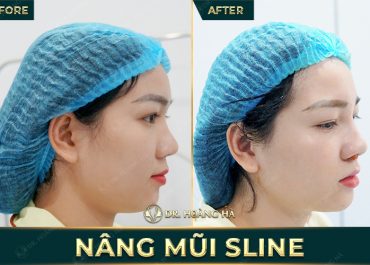 Top 4 dáng mũi đẹp cho nữ được yêu thích nhất 2025