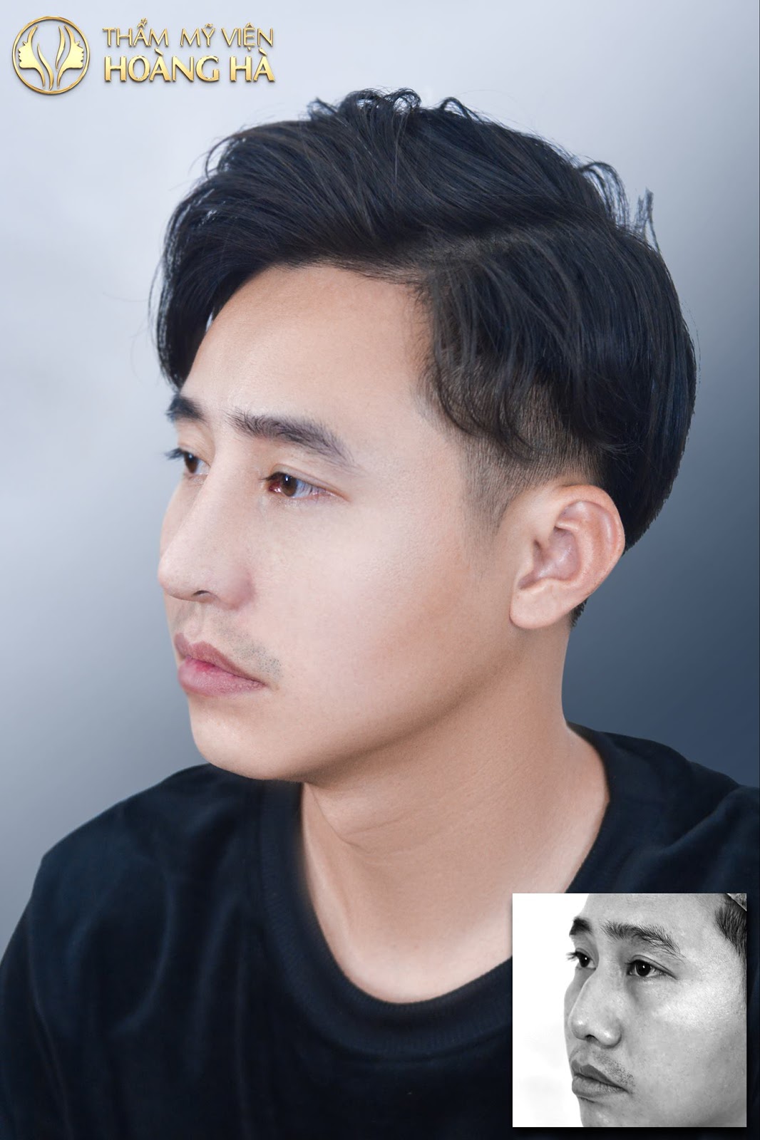 Khách hàng sau khi Nâng mũi L-line tại Dr Hoàng Hà