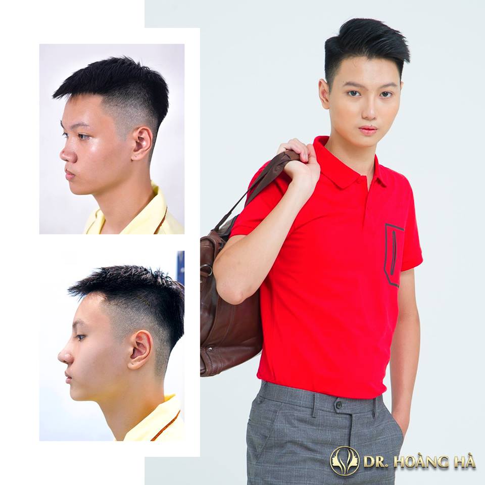 Nâng mũi cho nam – Mũi cao tây, tràn đầy vẻ nam tính