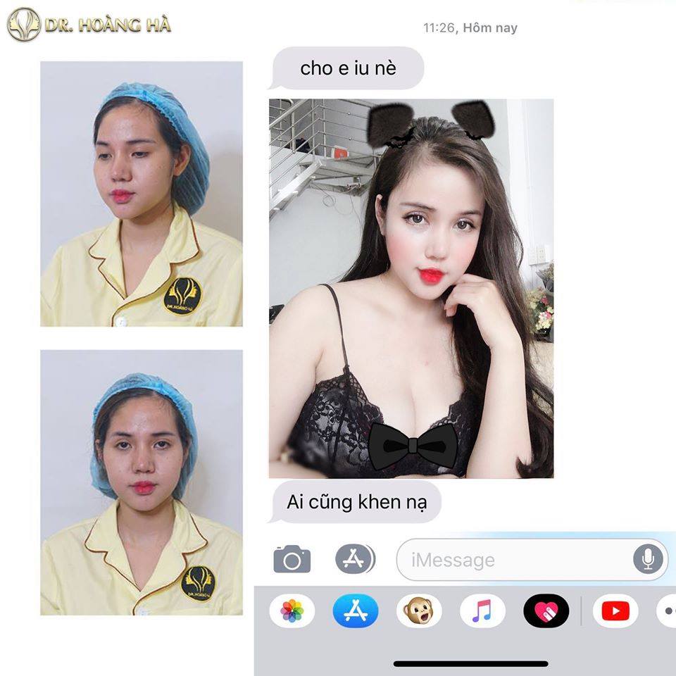 100% khách hàng hài lòng với dịch vụ thẩm mỹ độn thái dương bằng sụn của Dr Hoàng Hà
