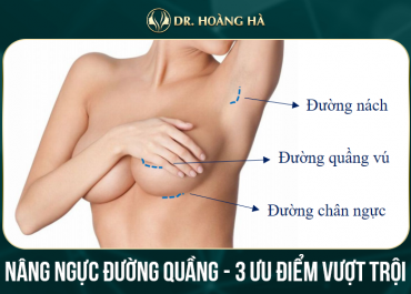 Nâng ngực đường quầng - 3 ưu điểm vượt trội