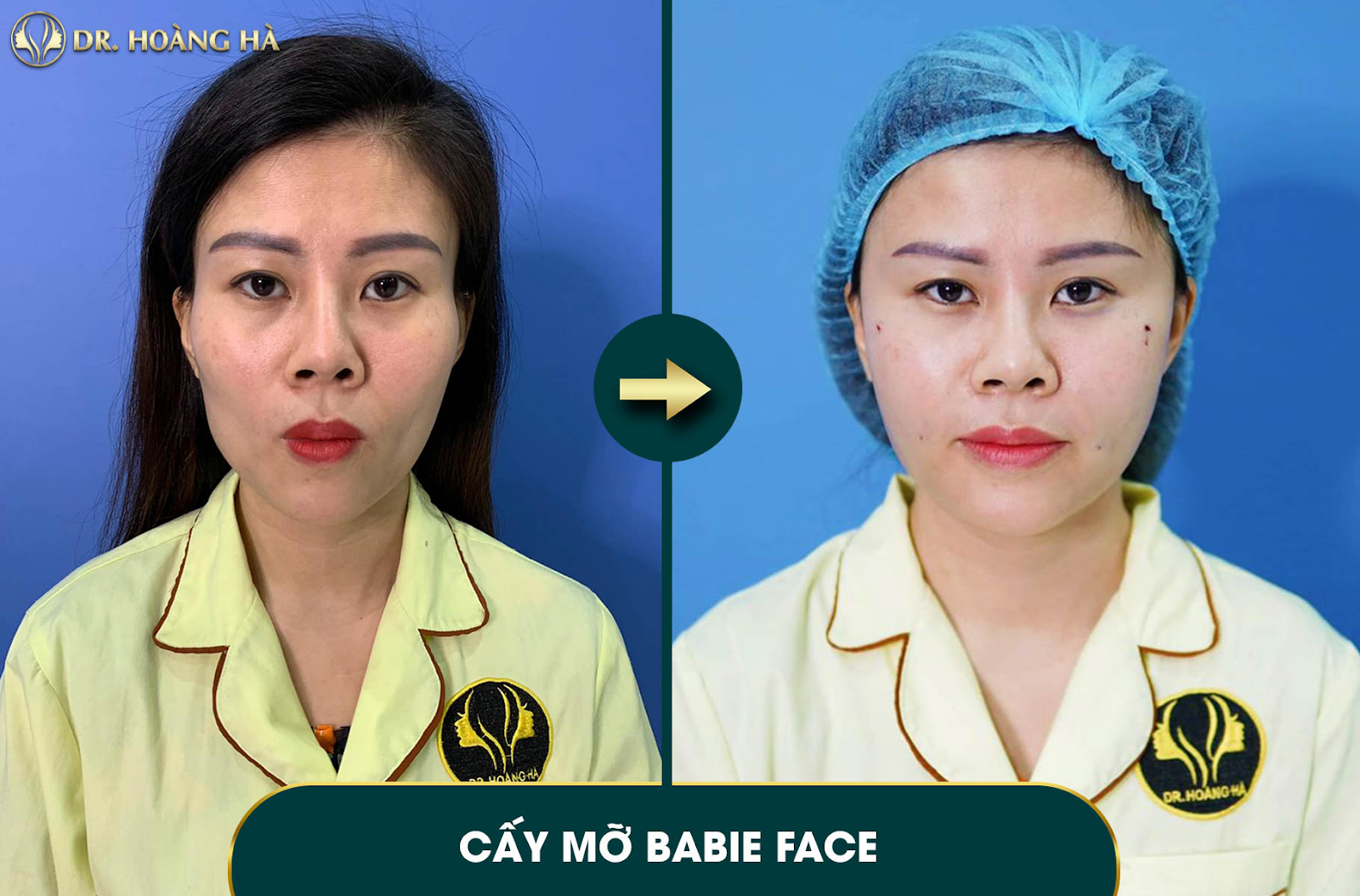 Cấy mỡ mặt là phương pháp tiên tiến nhất hiện nay