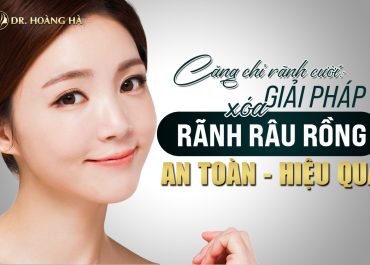 Căng chỉ rãnh cười: Giải pháp xóa nhăn rãnh râu rồng AN TOÀN HIỆU QUẢ