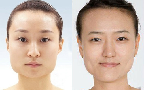 Tiêm botox gọn hàm - Giải pháp làm gọn khuôn mặt không phẫu thuật
