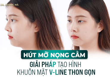 Hút mỡ nọng cằm - Giải pháp tạo hình khuôn mặt V line thon gọn