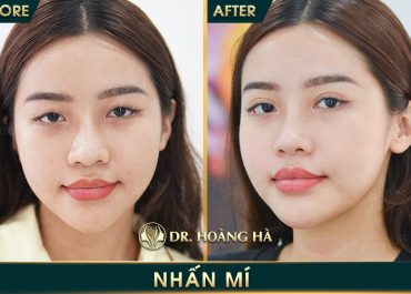  Nhấn mí mắt giá bao nhiêu tiền? Bảng giá mới nhất tại Dr Hoàng Hà 2021