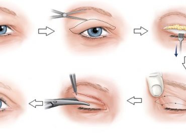 Nhấn mí mắt - Giải pháp tạo hình mắt 2 mí AN TOÀN không phẫu thuật
