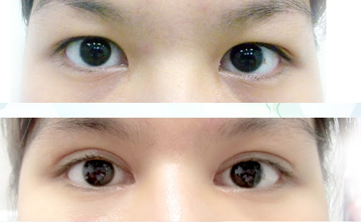 Mở rộng góc mắt - Cải thiện độ rộng của đôi mắt
