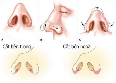 Thu gọn cánh mũi có để lại sẹo không? Ths. Bs Hoàng Hà “Giải đáp”