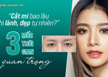 Cắt mí bao lâu thì lành, đẹp tự nhiên? 3 mốc thời gian quan trọng