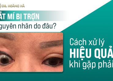 Cắt mí bị trợn nguyên nhân do đâu? Cách xử lý hiệu quả khi gặp phải