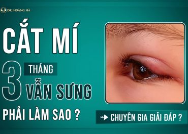 Cắt mí 3 tháng vẫn sưng phải làm sao? Chuyên gia giải đáp