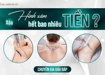 Xóa xăm hết bao nhiêu tiền? Chuyên gia giải đáp