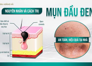 Nguyên nhân và cách trị mụn đầu đen an toàn, hiệu quả tại nhà