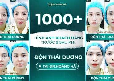 1000+ hình ảnh khách hàng trước và sau khi độn thái dương tại Dr Hoàng Hà