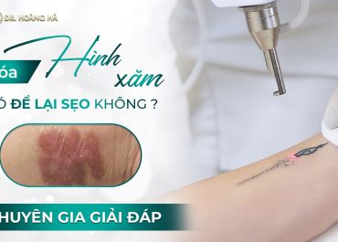 Xóa xăm có để lại sẹo không? Chuyên gia giải đáp