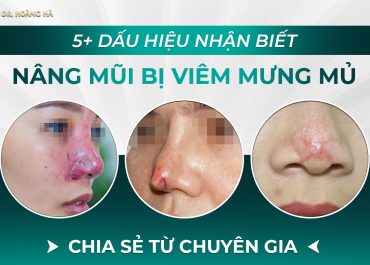 5+ dấu hiệu nhận biết nâng mũi bị viêm mưng mủ - Chia sẻ từ chuyên gia