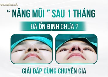 Nâng mũi sau 1 tháng đã ổn định chưa? Giải đáp cùng chuyên gia