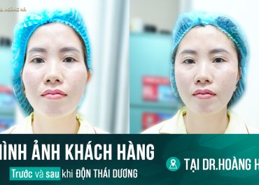 Hình ảnh khách hàng trước và sau khi độn thái dương tại Dr Hoàng Hà