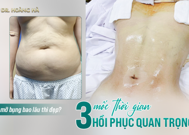 Hút mỡ bụng bao lâu thì đẹp - 3 Mốc thời gian hồi phục quang trọng