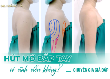 Hút mỡ bắp tay có vĩnh viễn không? - Chuyên gia giải đáp