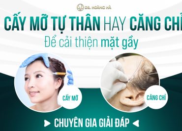 Nên cấy mỡ tự thân hay căng chỉ để cải thiện mặt gầy? Chuyên gia giải đáp