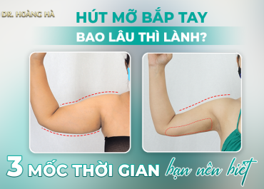 Hút mỡ bắp tay bao lâu thì lành? 3 mốc thời gian sau bạn nên biết