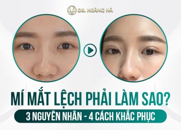 Mí mắt lệch phải làm sao? 3 Nguyên nhan - 4 Cách khắc phục