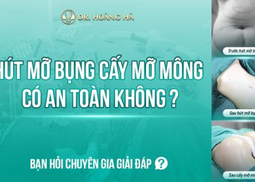 Hút mỡ bụng cấy mỡ mông có an toàn không? Bạn hỏi - Chuyên gia giải đáp