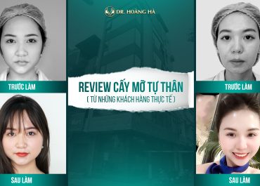 Review cấy mỡ tự thân từ những khách hàng thực tế 2022