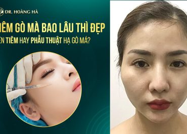 Tiêm hạ gò má bao lâu thì đẹp? Nên tiêm hay phẫu thuật hạ gò má?