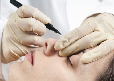 Sau khi nâng mũi có cần cắt chỉ không? Bác sĩ đầu ngành giải đáp 