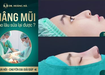 Nâng mũi bao lâu sửa lại được? Bạn hỏi - Chuyên gia giải đáp