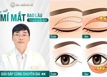 Lấy mỡ mí mắt bao lâu thì lành và ổn định? Giải đáp cùng chuyên gia