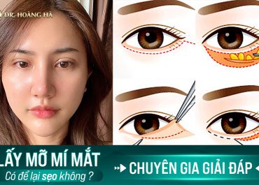 Lấy mỡ mí mắt có để lại sẹo không? Chuyên gia giải đáp