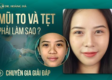 Mũi tẹt và to phải làm sao? Chuyên gia giải đáp