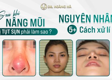 Sau khi nâng mũi bị tụt sụn phải làm sao? Nguyên nhân và 5+ cách xử lý