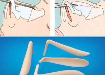Nâng mũi bằng sụn tai có tốt không? Ưu - Nhược điểm bạn cần khi thực hiện