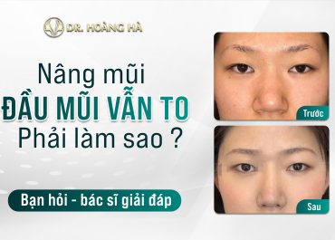 Nâng Mũi 1 tháng đầu mũi vẫn to phải làm sao? Bạn hỏi  - Bác sĩ giải đáp